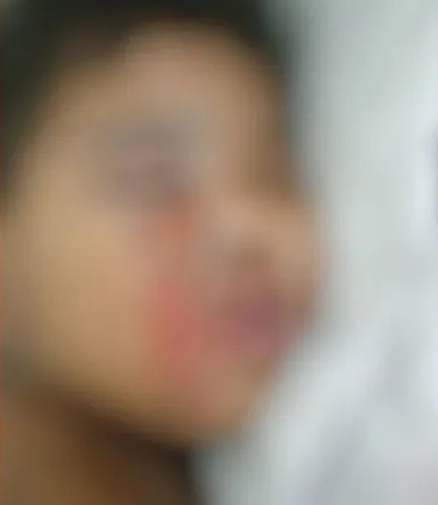 Bebê é internada após ser queimada com cigarro em Teófilo Otoni; pai é o principal suspeito do crime