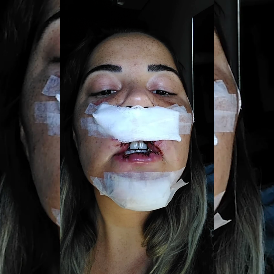 Influencer que perdeu lábio em harmonização com PMMA começa a reconstruir rosto: 'fui enganada'