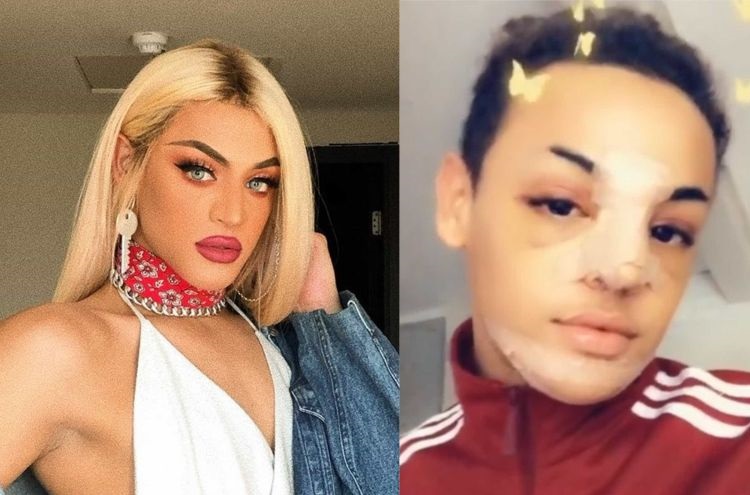 Pabllo Vittar passa por três cirurgias no rosto: ' Não foi por estética"